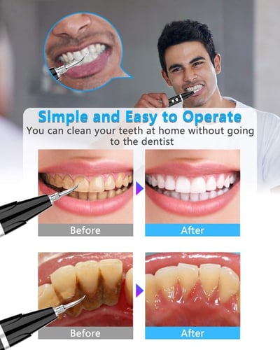 Electric Ultrasonic tooth cleaner